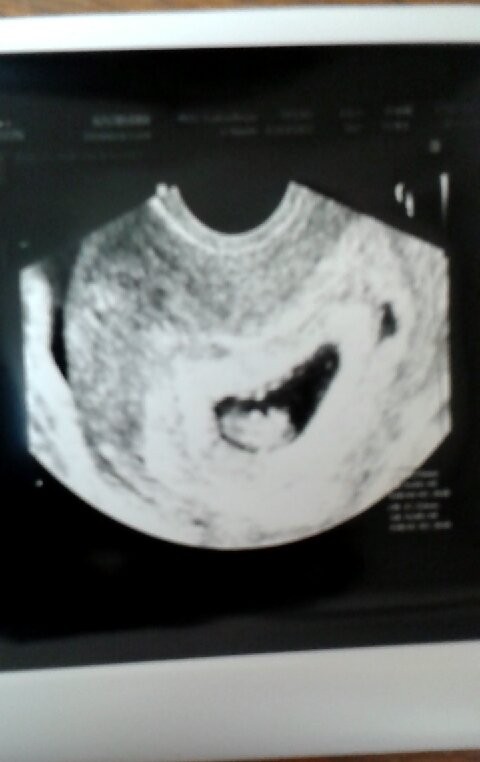 ultrazvuk snímek